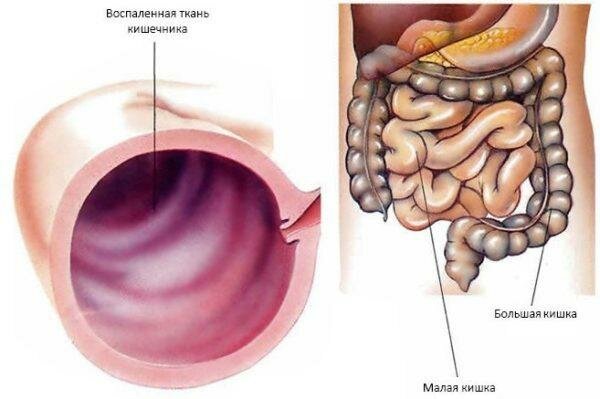 Энтероколит кишечника: симптомы